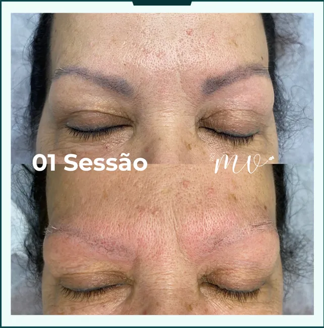antes depois 05